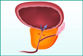 Enlargement of the prostate gland and compression of the urethra