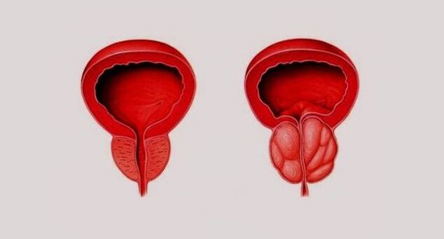 Healthy prostate (left) and inflamed prostate gland (right)