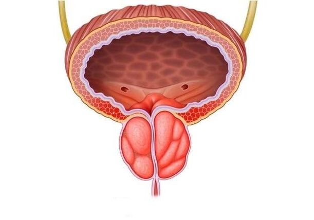 prostatitis in men