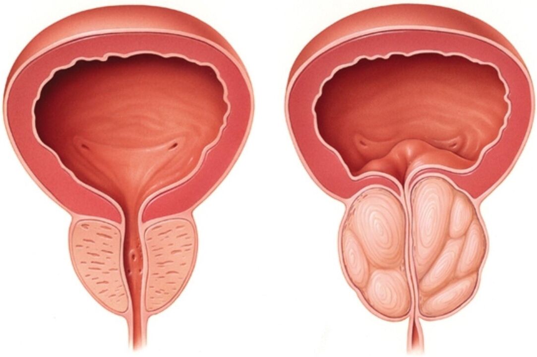 Normal prostate (left) and signs of inflammation in prostatitis (right)