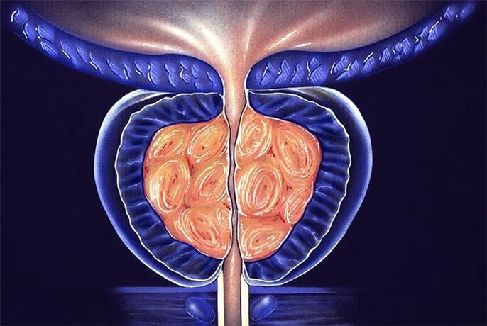 prostatitis in men