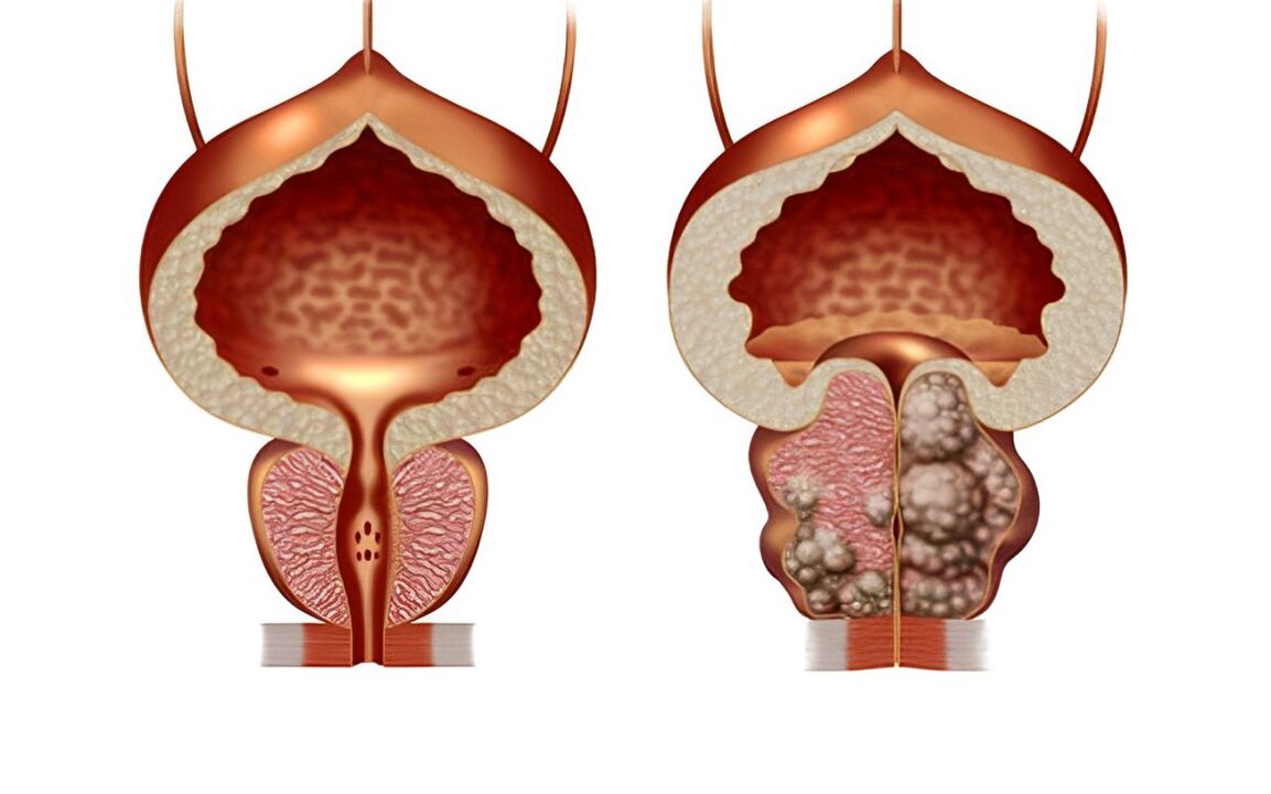 What does a prostate tumor look like 