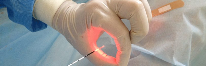 Effective laser treatment of prostatitis in men
