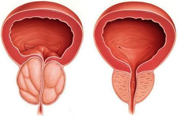 the prostate is healthy and inflamed with prostatitis